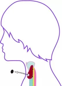 ENUCLEATION: The thyroid nodule is removed from the thyroid gland along its capsule.