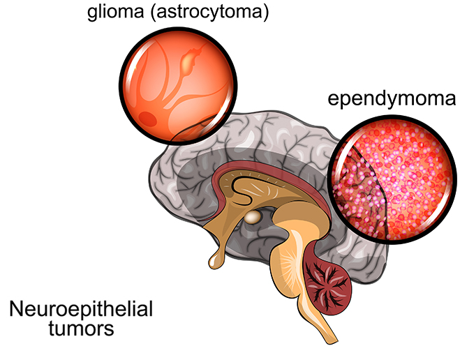 Types of Glioma (neuroepithelial tumor) - Astrocytoma originating from Astrocytes, Ependymoma originating from Ependymocytes