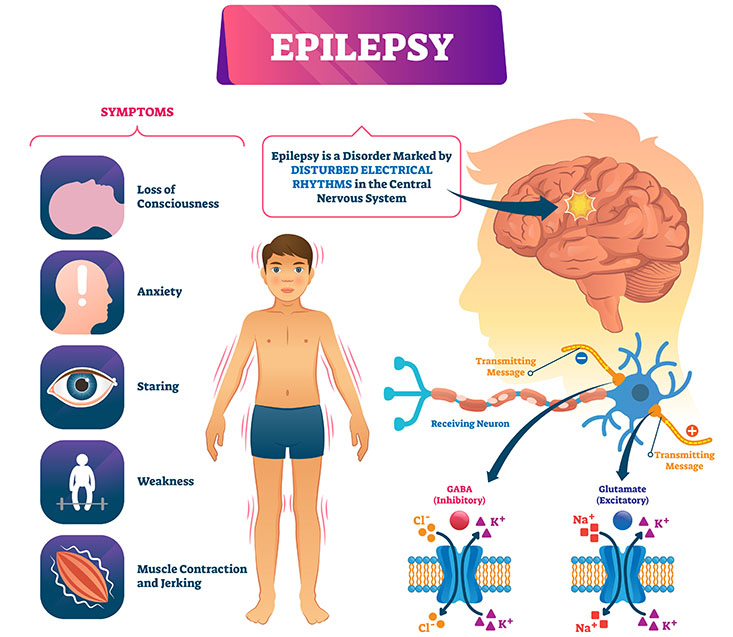Disturbed Electrical Rhythms in the Pediatric Brain and Central Nervous System causing symptoms of Epilepsy