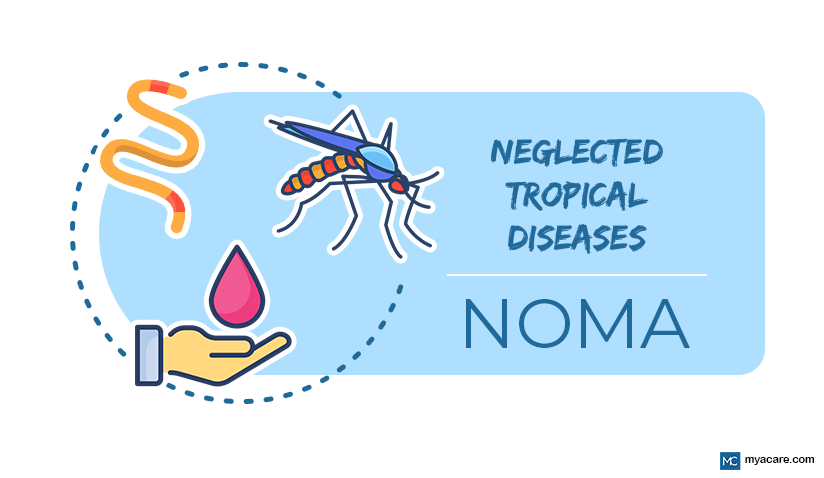 NOMA: THE LATEST NEGLECTED TROPICAL DISEASE SPOTLIGHTED BY THE WHO