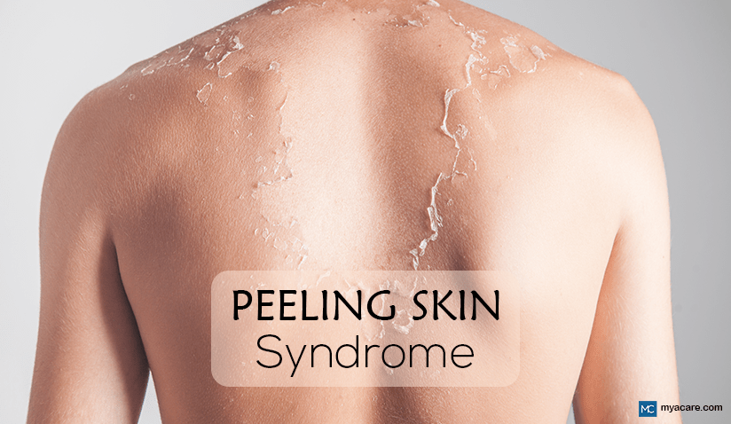 PEELING SKIN SYNDROME: CAUSES, SYMPTOMS, AND MANAGEMENT