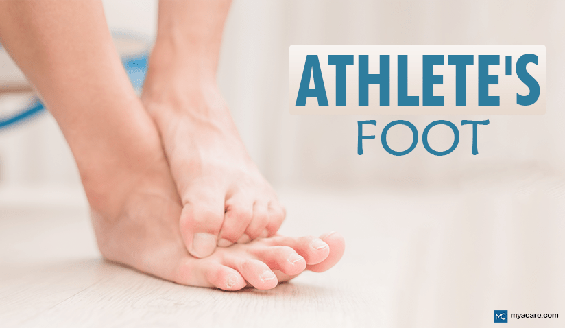 ATHLETE’S FOOT: CAUSES, SYMPTOMS, AND SOLUTIONS