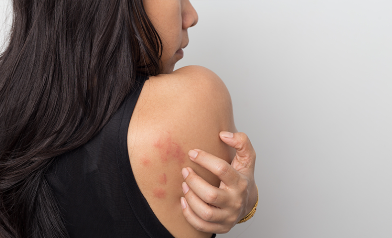 WHAT IS URTICARIA (HIVES)