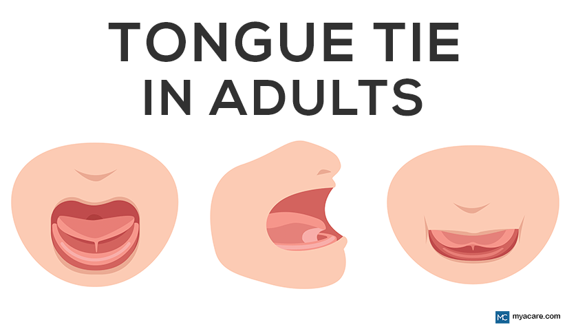 ADULT TONGUE TIE: HOW TO SPOT, SYMPTOMS AND TREATMENT 