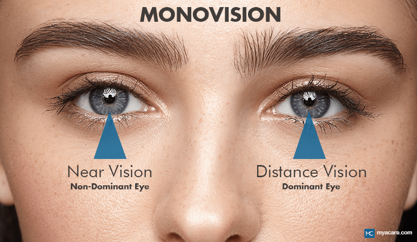 WHAT IS MONOVISON AND HOW DOES IT CORRECT PRESBYOPIA