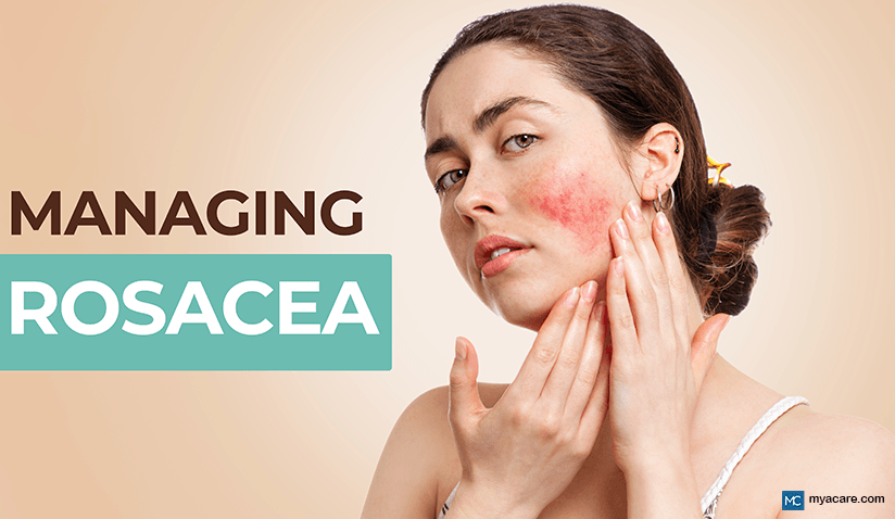 UNDERSTANDING AND MANAGING ROSACEA: SYMPTOMS, TRIGGERS, PREVENTION, AND TREATMENT OPTIONS