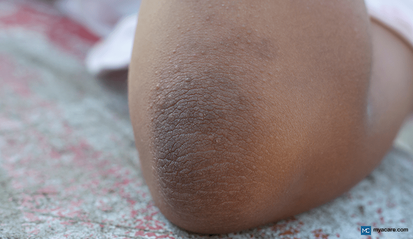 ACANTHOSIS NIGRICANS- CAUSES, DIAGNOSIS AND TREATMENT
