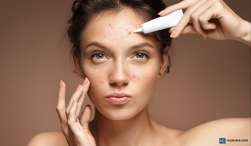 UNDERSTANDING PIMPLES: CAUSES, TYPES, AND EFFECTIVE TREATMENT STRATEGIES