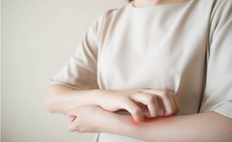 TIPS TO PREVENT ECZEMA FLARES