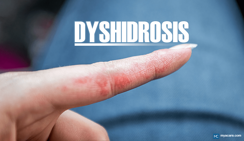 ALL YOU NEED TO KNOW ABOUT DYSHIDROSIS