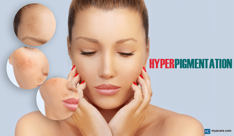 TREATMENTS FOR HYPERPIGMENTATION