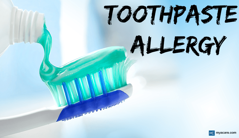 TOOTHPASTE ALLERGY: SYMPTOMS, CAUSES, DIAGNOSIS, TREATMENT, AND PREVENTION