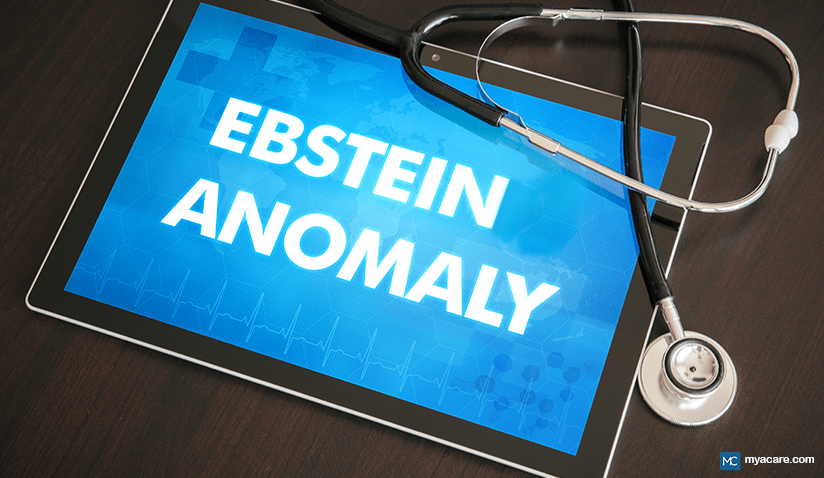 EBSTEIN ANOMALY: A COMPLEX HEART DEFECT