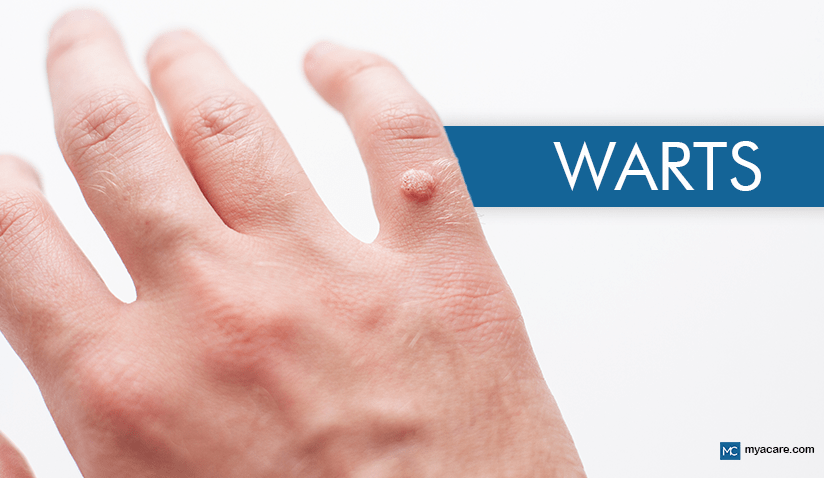 WARTS: TYPES, CAUSES, AND THE LATEST TREATMENTS