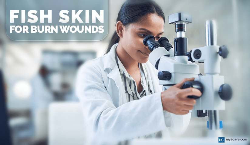 FISH SKIN FOR BURN WOUNDS: THE FUTURE WOUND DRESSING? 