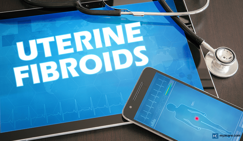 UTERINE FIBROIDS: WHAT YOU NEED TO KNOW TO MAKE INFORMED DECISIONS