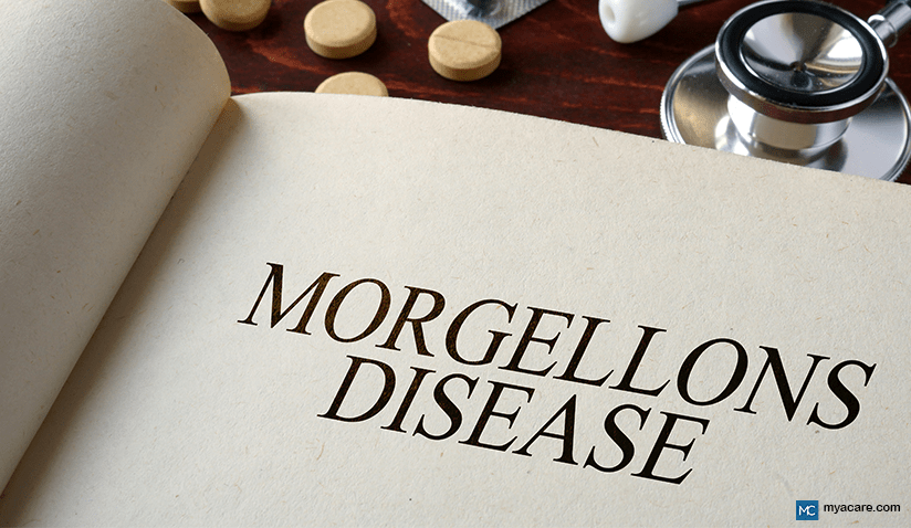 MORGELLONS DISEASE: EXPLAINING THE CONTROVERSY, CAUSES, RISKS, AND MORE