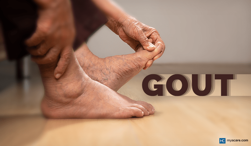 GOUT: BIG TOE PAIN - CAUSES, DIAGNOSIS, HOME REMEDIES, AND MORE