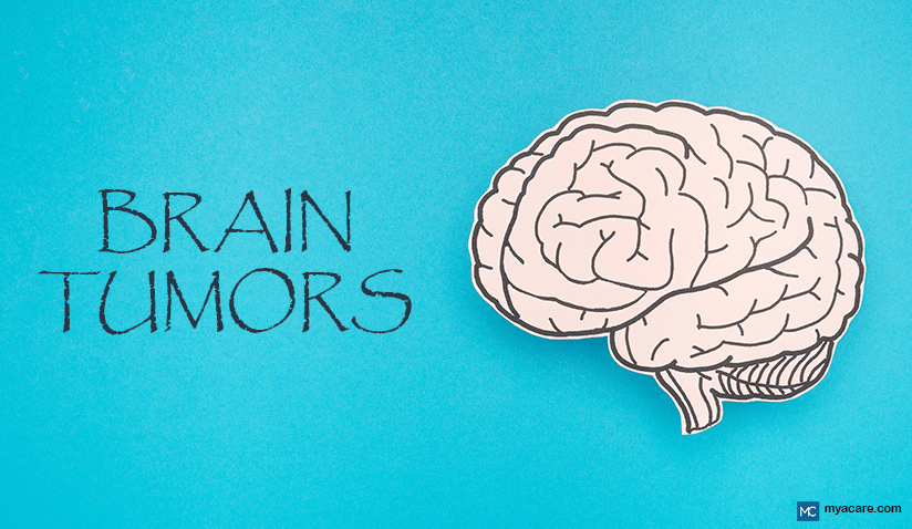 BRAIN TUMORS: TYPES, CAUSES, AND EMERGING TREATMENTS