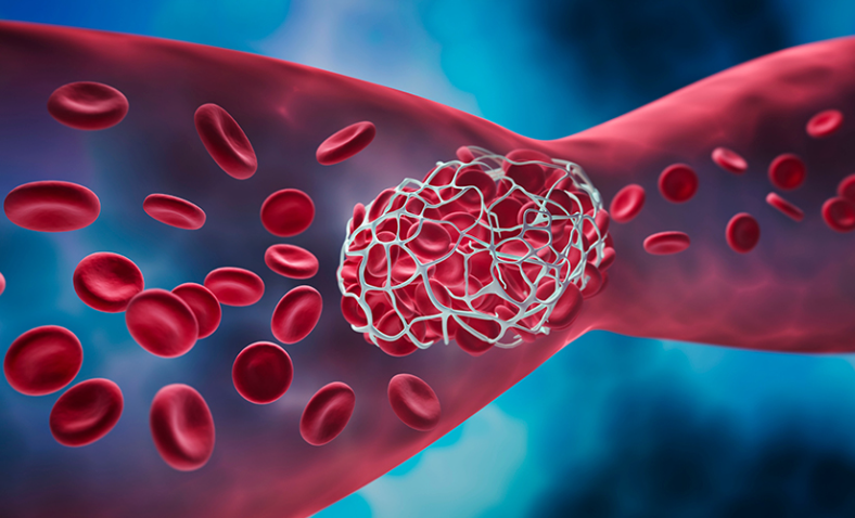 RISKY BLOOD CLOTS - LEARN WHEN BLOOD THINNERS ARE USEFUL