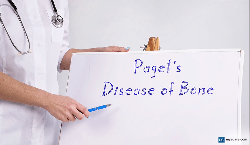 PAGET’S DISEASE OF BONE: SYMPTOMS, DIAGNOSIS, TREATMENT AND MORE
