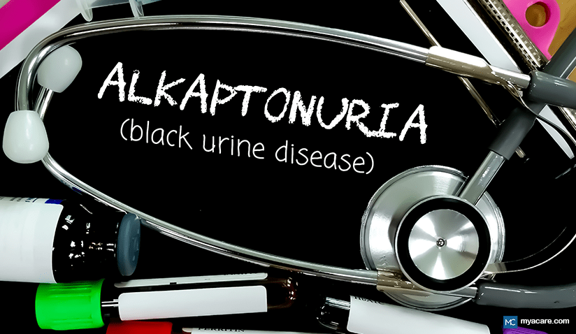 ALKAPTONURIA: THE RARE DISEASE THAT TURNS URINE BLACK 