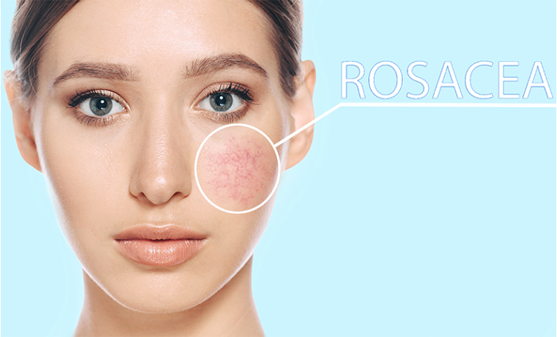 ROSACEA: WHAT YOU NEED TO KNOW