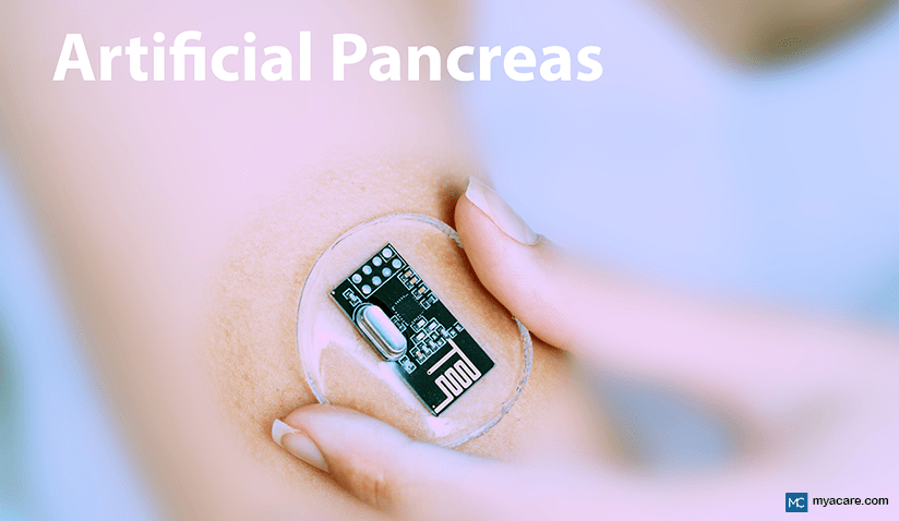 ARTIFICIAL PANCREAS TECHNOLOGY FOR DIABETES MANAGEMENT: TYPES AND BENEFITS