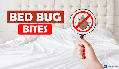 BED BUG BITES: SYMPTOMS, PREVENTION, AND HOW TO TREAT