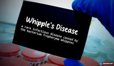 UNDERSTANDING WHIPPLE’S DISEASE: TRANSMISSION, SYMPTOMS, AND TREATMENT OPTIONS