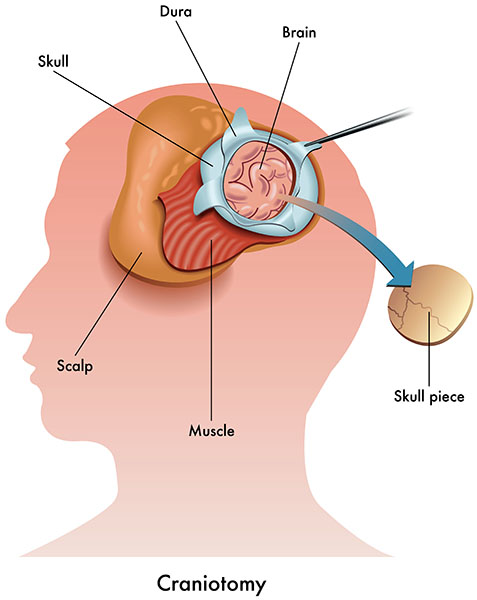 Craniotomy - surgical removal of a small piece of the skull exposing part of the brain with its Dura, Muscle and the Scalp
