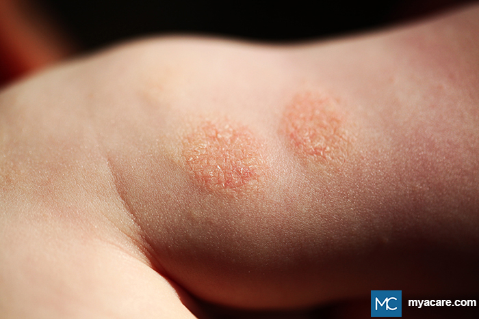 Nummular Eczema - Coin-shaped, itchy, red lesions on the skin