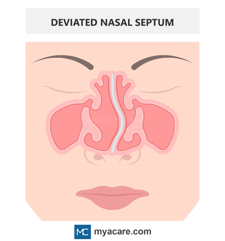 Normal Nasal Septum separates nostrils evenly vs Deviated Nasal Septum - septum crooked, nostrils appear uneven