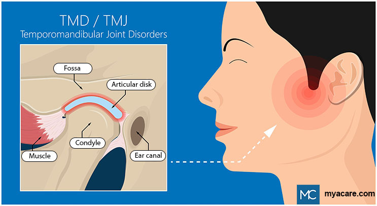 Temporomandibular Joint (TMJ/TMD) near ear connects lower jaw to skull and is comprised of condyle, fossa and articular disk