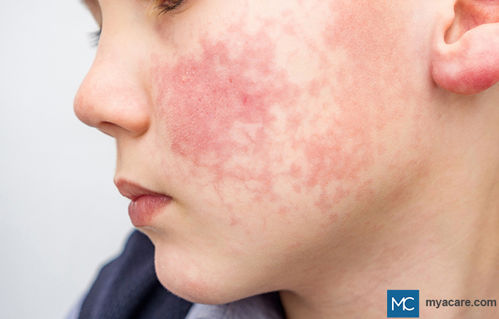 Erythema infectiosum - bright-red lesions on the cheek which look like 'slapped-face'