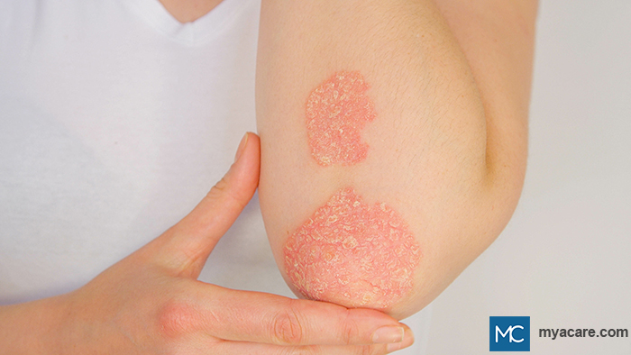 Psoriasis - thick plaques having white, scaly surfaces seen on elbow