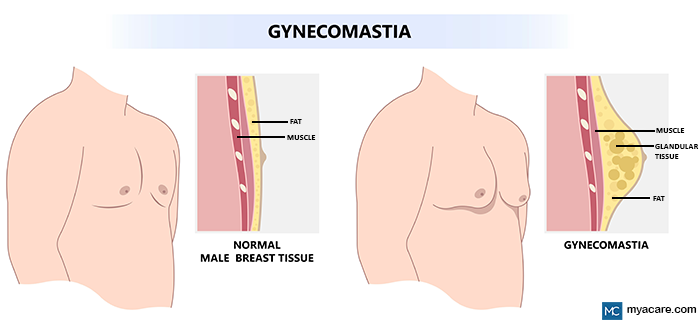 Left: Normal male breast (fat,muscle); Right: Enlarged breast size due to Gynecomastia (fat, muscle, glandular tissue growth)
