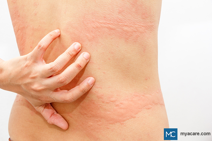 Urticaria - red, itchy bumps or wheals (hives) on the skin