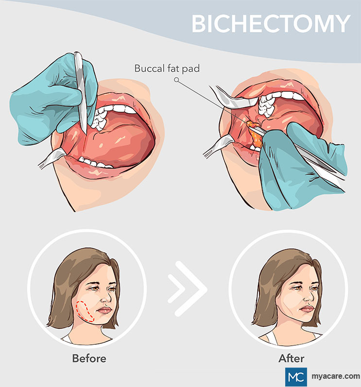 Bichectomy procedure showing before and after comparison and removal of buccal fat pad