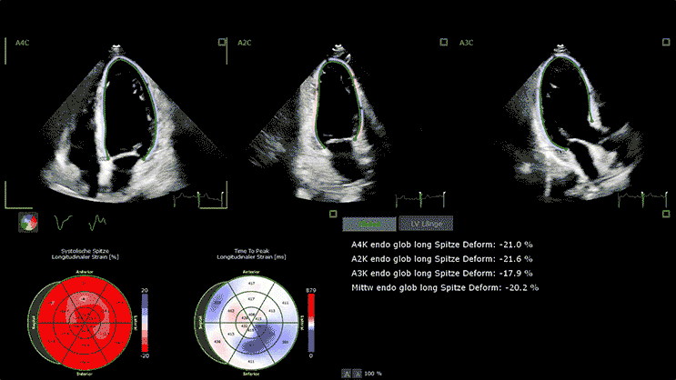 Philips Strain imaging of the heart