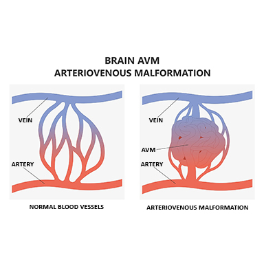 Normal blood vessels - artery, vein, capillaries (L), Arteriovenous Malformation (AVM) in between the artery and vein (R)