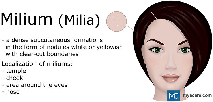 Milium/Milia - Small white or yellowish bumps on the temple, cheek, nose and around eyes due to keratin trapped under skin