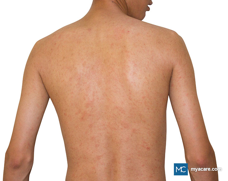 Pityriasis Rosea - multiple small round pinkish lesions seen on the back.