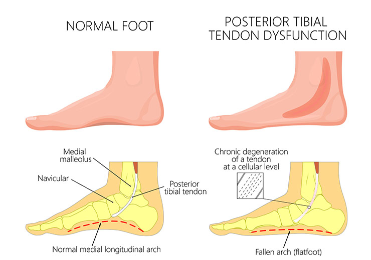 Comparison of normal foot vs posterior tibial tendon dysfunction which shows chronic degeneration of tendon and fallen arch