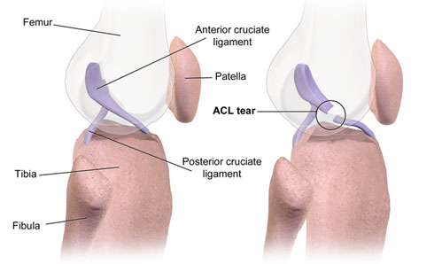 Normal knee joint (left), knee joint with ACL tear (right)