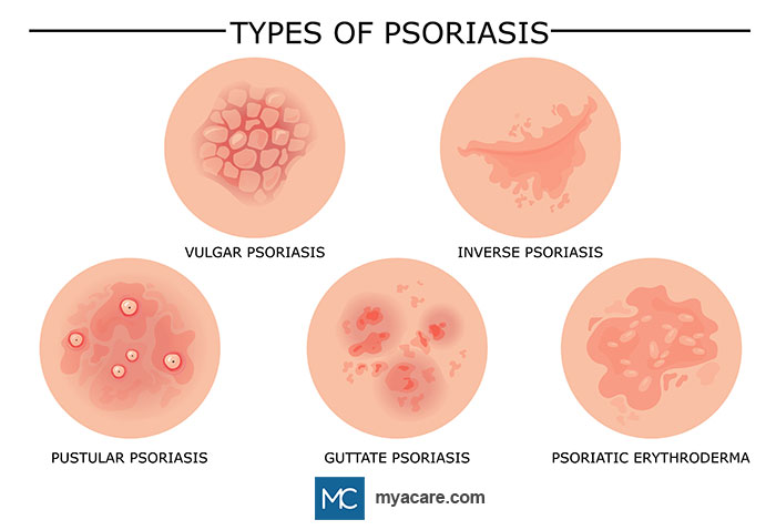 Types of Psoriasis: Pustular Psoriasis, Guttate Psoriasis, Vulgar Psoriasis, Erythrodermic Psoriasis and Inverse Psoriasis
