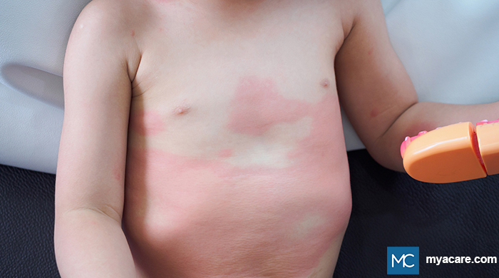 Drug Hypersensitivity Reactions - maculopapular, red, itchy rashes seen on the abdomen