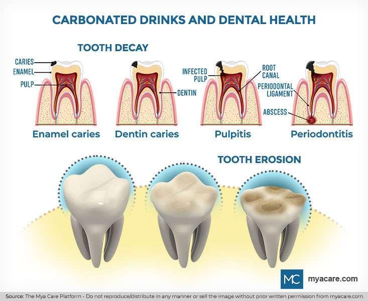 Effects of carbonated drinks on teeth: tooth decay, caries, infected pulp, pulpitis, abscess, periodontitis and tooth erosion
