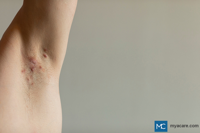 Hidradenitis Suppurativa - nodules or lumps seen in the hair follicles of the armpit