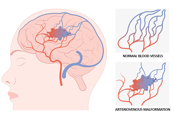 Arteriovenous Malformation location in Brain (L), Normal Blood Vessels (Top right), Arteriovenous Malformation (Bottom right)